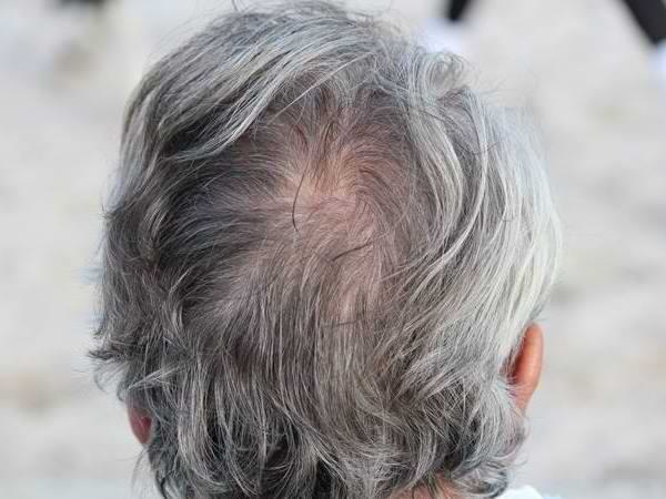Por qué salen las canas: disminución de melanocitos y las canas