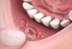 ¿Por qué salen llagas en la boca?